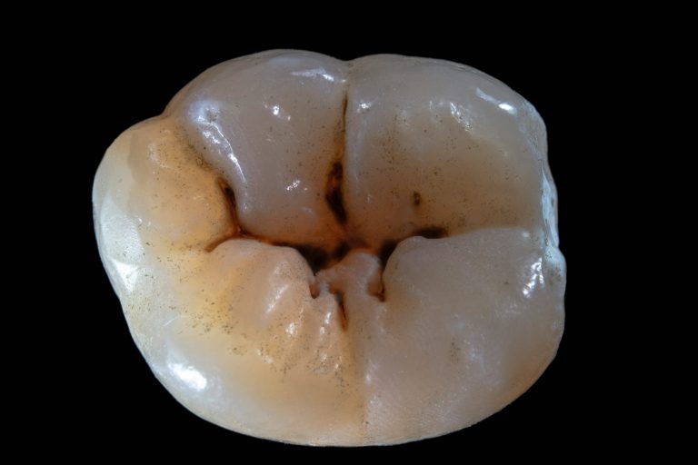 Sealants and Fillings – Copy