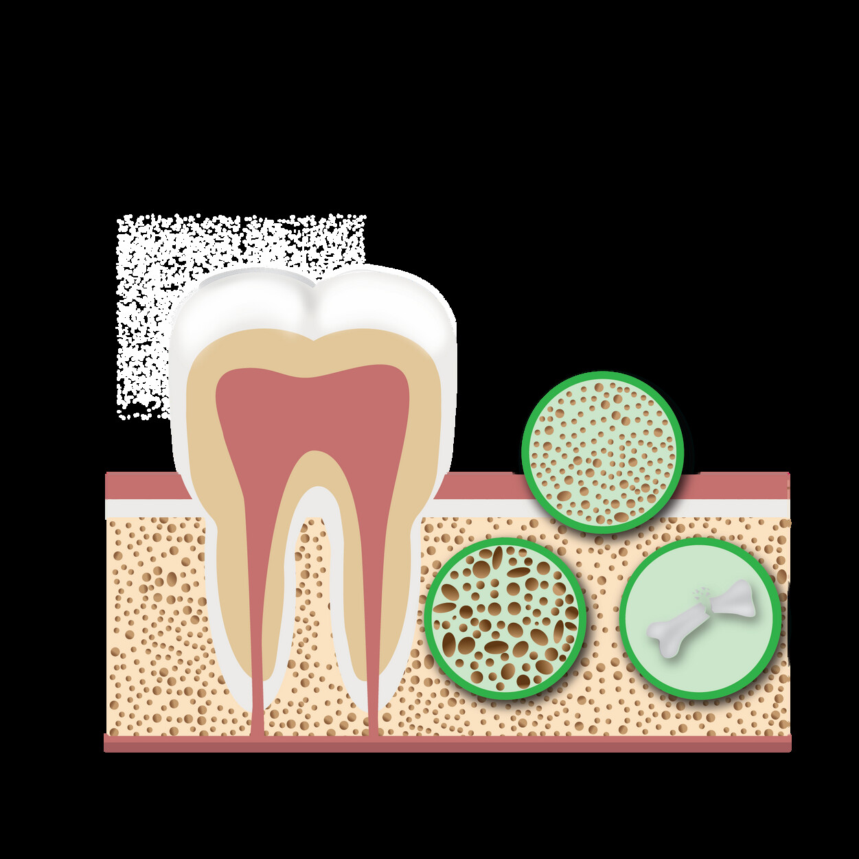 Illustration showing osteoporosis-related bone-density changes around a tooth